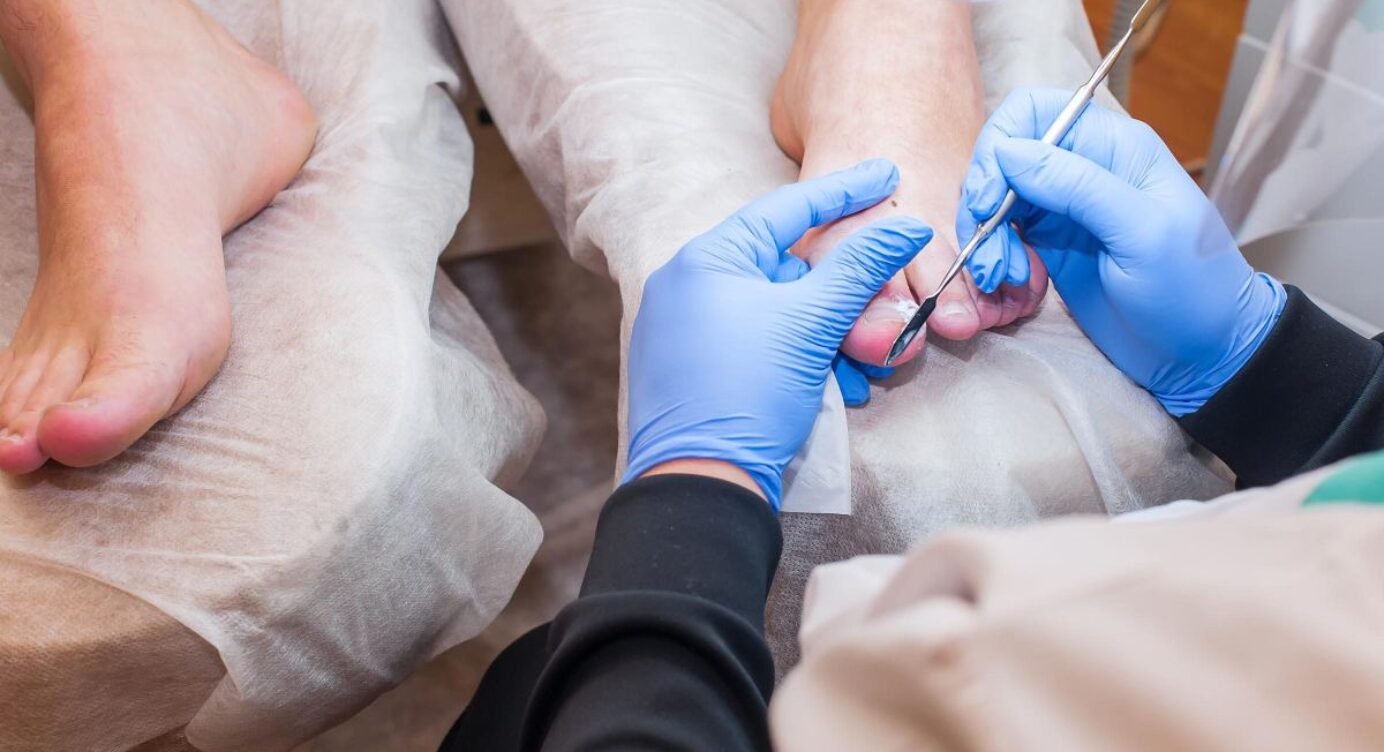 Whats Causes Toenail Fungus